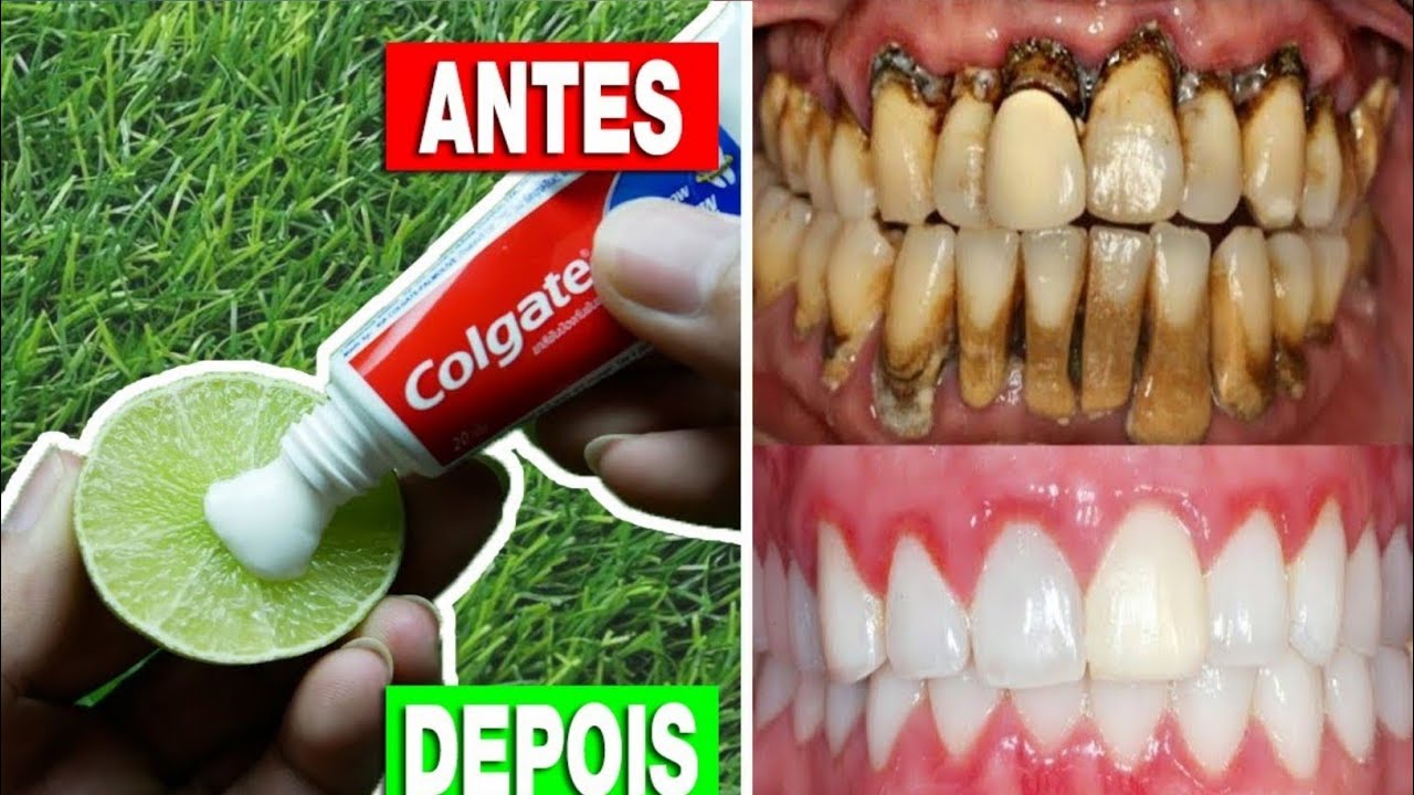 Cuanto Tiempo Se Tarda En Blanquear Los Dientes como blanquear los dientes - YouTube