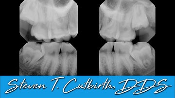 Sectioning, Extraction & Packing of Four Impacted Wisdom Teeth - with Steven T. Cutbirth, DDS