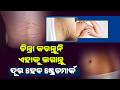 Stretch Marks Remedy: Apply This &amp; Watch Them Fade Away | Health Tips