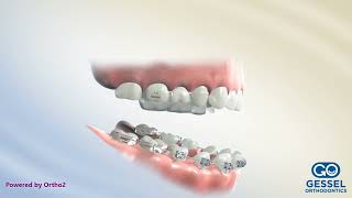 Anterior Crossbite RPE Correction