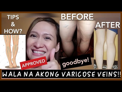 Paraan para mawala ang Varicose Veins. Pinaka mabisang Solusyon! My own experience.