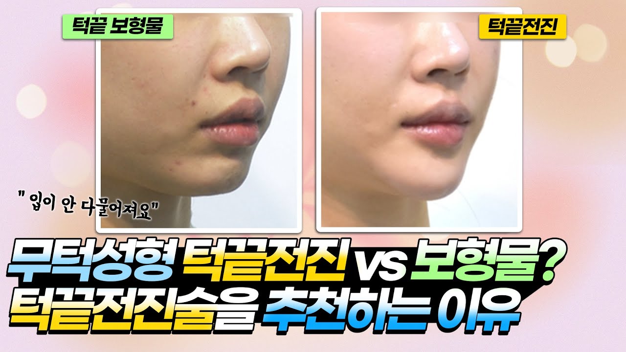 무턱성형 턱끝전진 vs 보형물 ? 턱끝전진술을 추천하는 이유 #무턱보형물 #무턱수술 #턱끝전진술 #턱끝수술 - YouTube