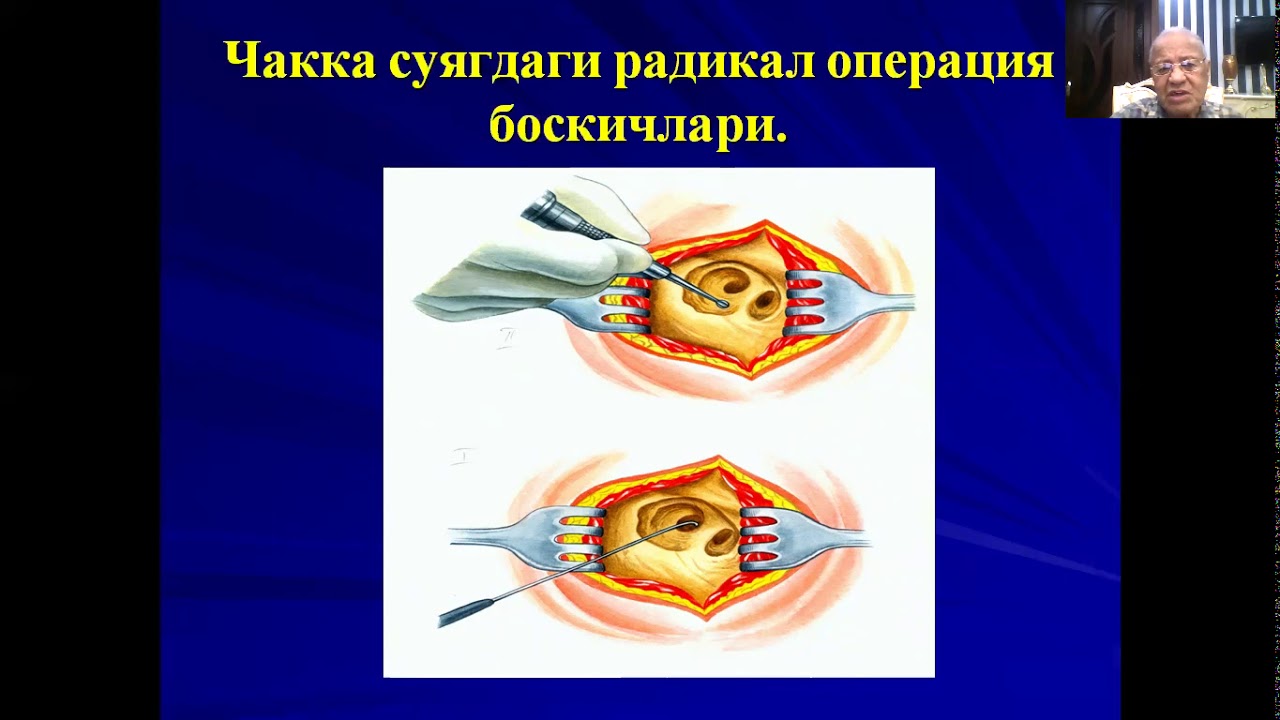 Сурункали йирингли ўрта отит