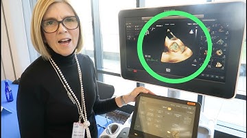 3D Echocardiogram of the Aortic Valve