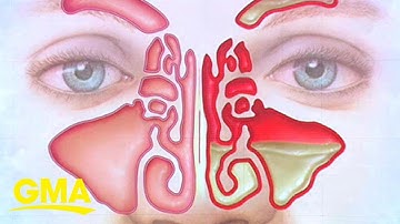 How to treat sinus infection symptoms at home