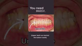 Do you need braces  ⬇️⬇️ watch this to find out