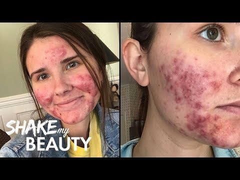 Going Out With My Severe Acne For The First Time | SHAKE MY BEAUTY