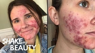 Going Out With My Severe Acne For The First Time | SHAKE MY BEAUTY