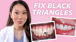 Fix Gaps In Teeth - How To Close Black Triangles
