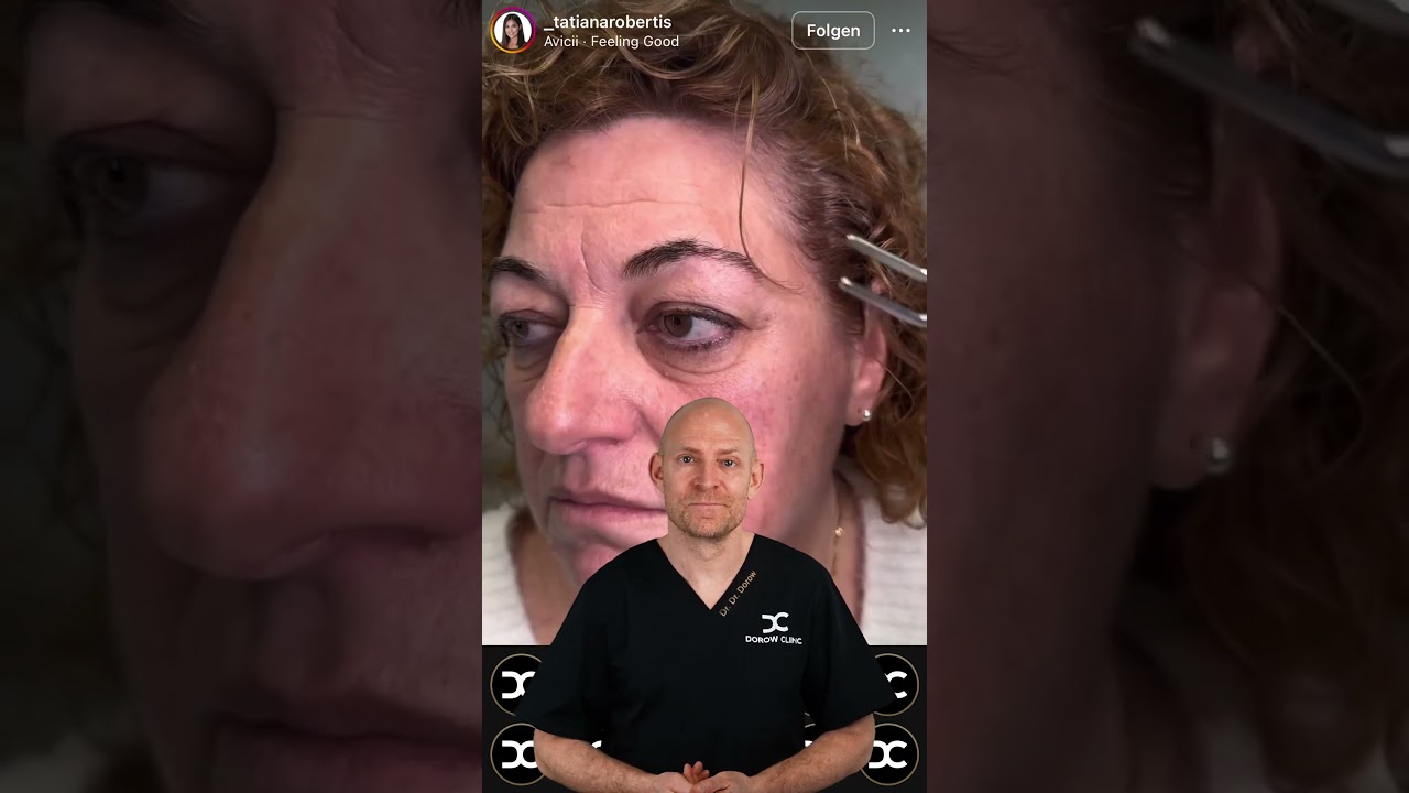 Extremer Hautüberschuss vor Oberlidstraffung 