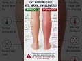 🦵 Deep Vein Thrombosis (DVT): The Hidden Blood Clot #Shorts
