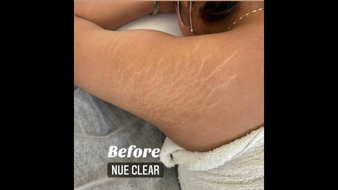 Stretch Mark Camouflage with Nue Conceal Australia