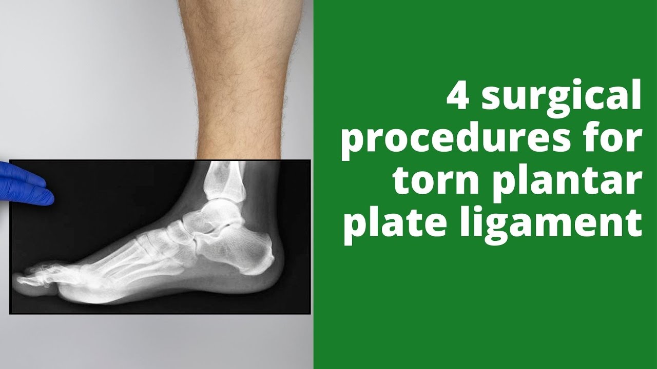 4 surgical procedures for torn plantar plate ligament YouTube
