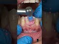 DentalCleaning #TeethScaling #TeethWhitening #DentistLife #HealthySmile #DentalCare #OralHealth