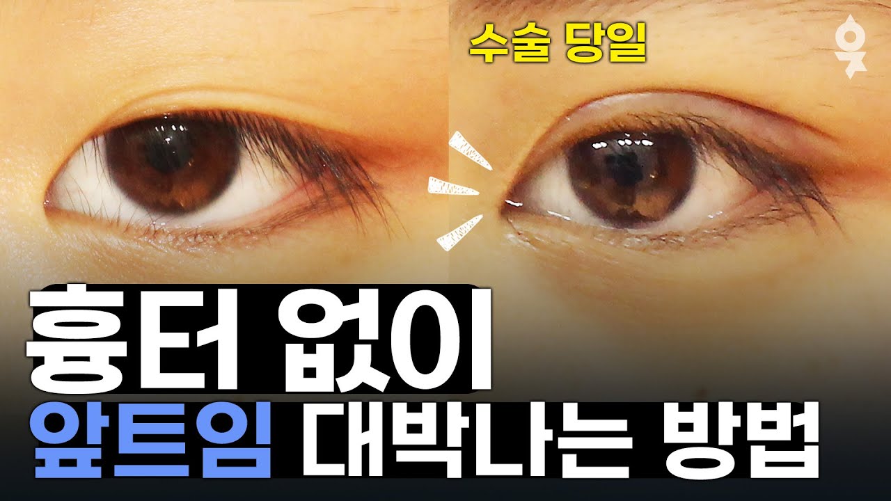 앞트임 노출흉터 ! 앞트임 흉터 때문에 고민이라면?! - YouTube