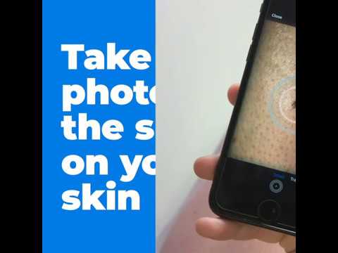 SkinVision - Find Skin Cancer