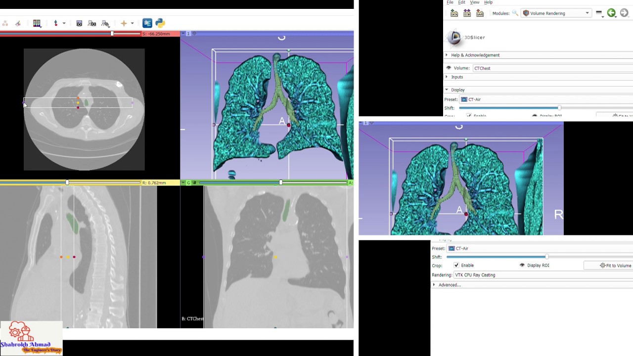 Airways Segmentation from CT Scan || 3D-Slicer || Airways segmentation tutorial || Bangladesh