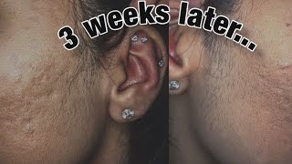 DERMAPLANING REGROWTH | AFTERMATH (DARK VELLUS HAIR!) *WITH PICTURES*
