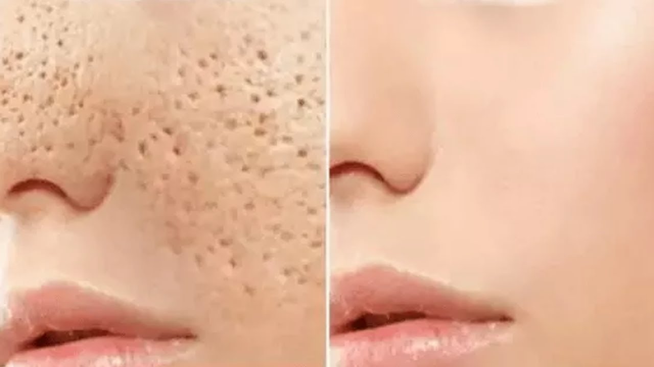 How to Get Rid of Large Skin Pores Within 24 Hours & Get Healthy Skin By The Beauty Expert