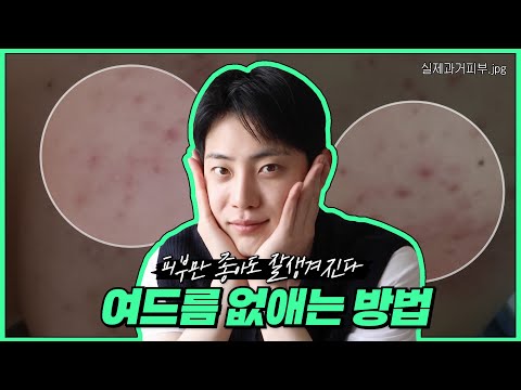 <strong>여드름</strong> 없애는 5가지 방법*<strong>피부과</strong> <strong>약</strong> 처방 후기부터 생활 습관까지 전부 알려줌#여드름관리
