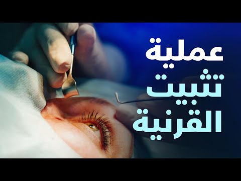 تفاصيل عملية تثبيت القرنية د احمد حتاتة
