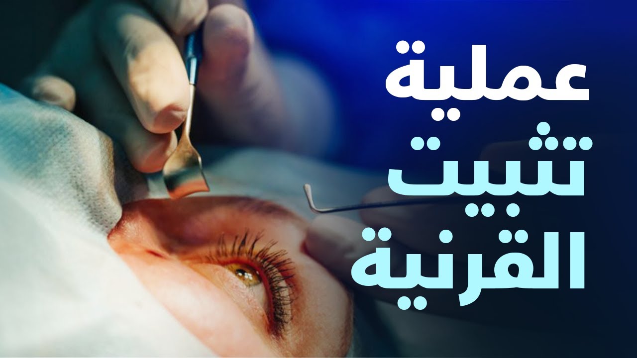 تفاصيل عملية تثبيت القرنية | د.احمد حتاتة