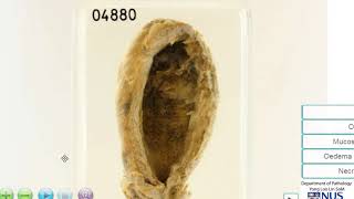 Gallbladder Acute cholecystitis
