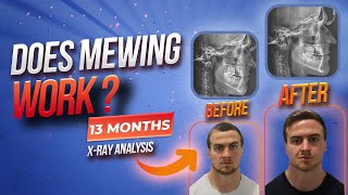Does Mewing Really Work For Adults? 13 Month Beforeafter X-Ray Analysis