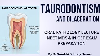 Taurodontism & Dilaceration- Oral Pathology Lecture |NEET MDS OR INICET EXAM 