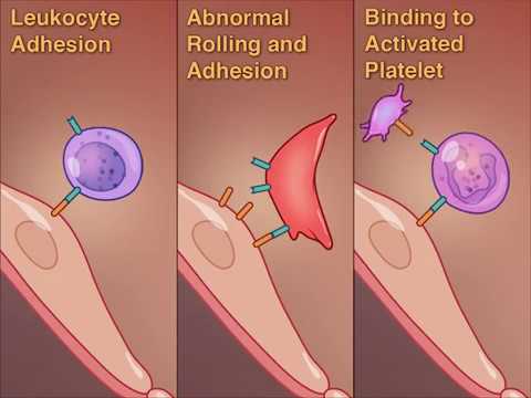 Crizanlizumab for the Prevention of Pain Crises in Sickle Cell Disease