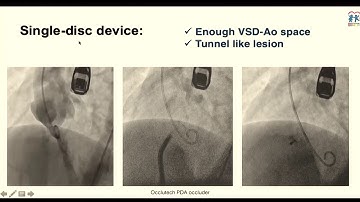 Device parade for VSD closure