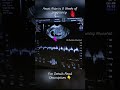 8 Weeks Pregnancy Baby Heart Rate seen On Ultrasound Scan