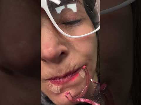 علاج تجاعيد حول الشفة بالليزر علاج ارتخاء الجلد حول الفم