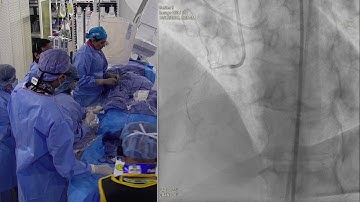 Recanalization of a complex RCA CTO using Antegrade/Retrograde Approach