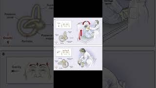 Dix-Hallpike Test for Vertigo (BPPV) #ent #meded #physiotherapy #vertigo