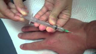 How to remove your ganglion cyst