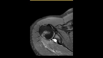 Suprascapular nerve compression from large paralabral cyst