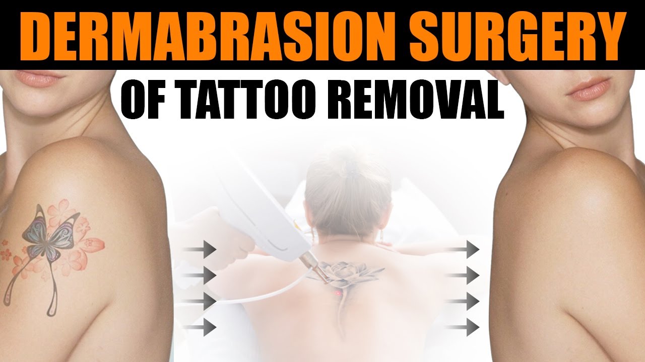 Laser Tattoo Removal  MSA Plastic Surgery