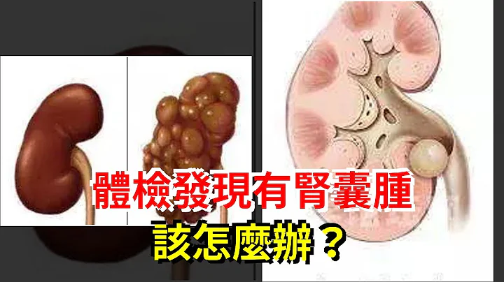 體檢發現有腎囊腫該怎麼辦？ - 天天要聞