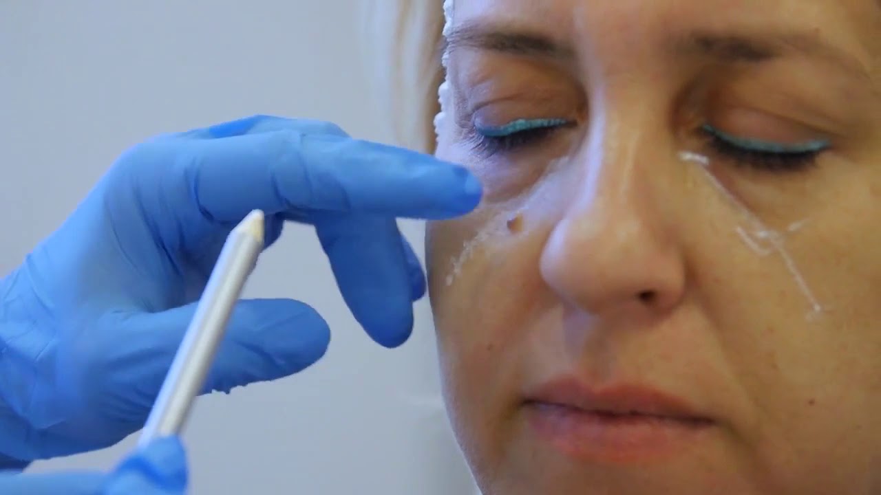 Wypełnienie i korekta doliny łez czyli likwidacja cieni i dołów pod oczami