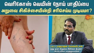 Nalam Tharum Maruthuvam | Varicose Veins நோய் பாதிப்பை அறுவை சிகிச்சையின்றி சரிசெய்ய முடியமா?