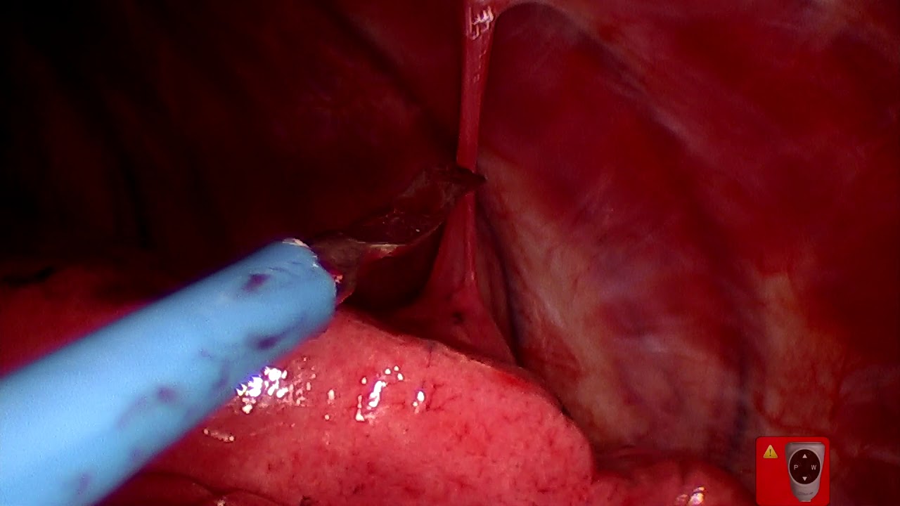 Sellado Pleural con Steritalc® pectus excavatum chirurgie