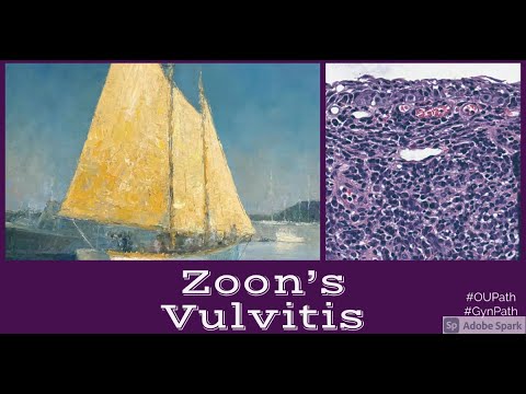 Plasma Cell Vulvitis Zoon's