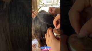 Part 118 Lice Removal Treatment Advanced Lice Picking Secrets