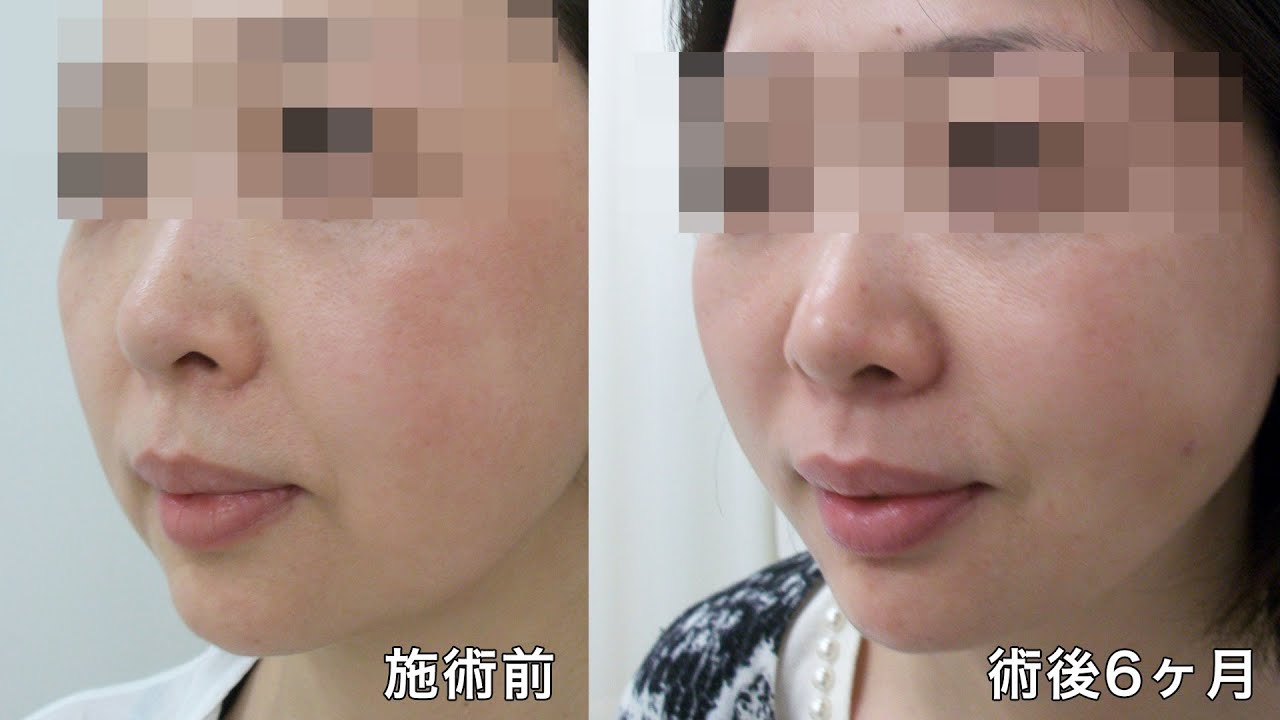 たるみ治療ｄｒ境のブログ