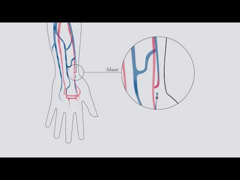 Understanding hemodialysis