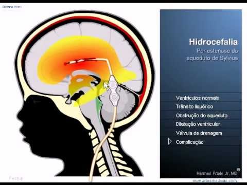 Hidrocefalia