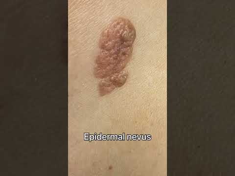 ازالة وحمة مع الدكتور وليد زاده