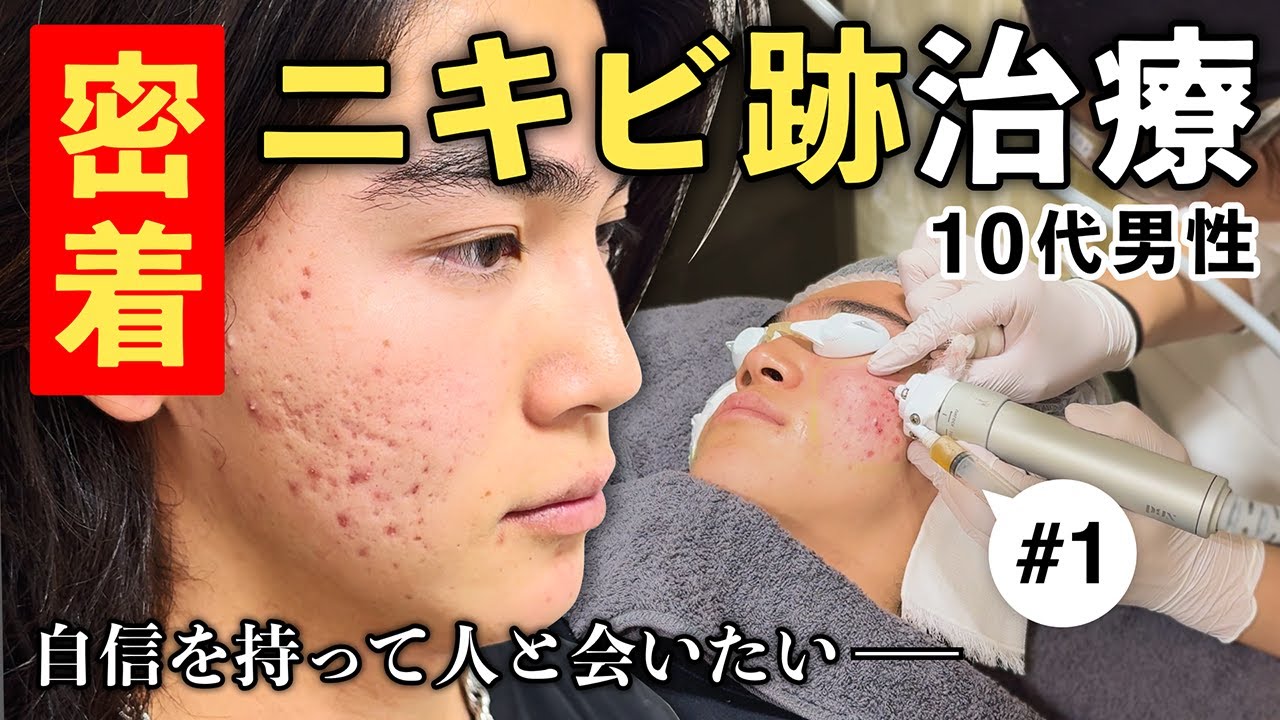 【ニキビ跡治療密着 前編】カウンセリングから治療初日まで全部見せます