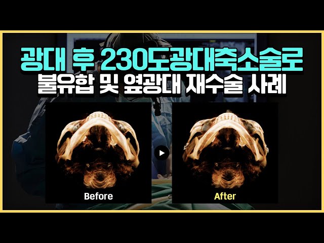 불유합 및 옆광대재수술 간단하게 해결방법은 없을까?